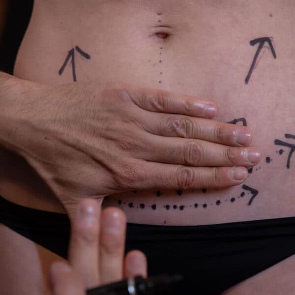 liposuction-mock-up