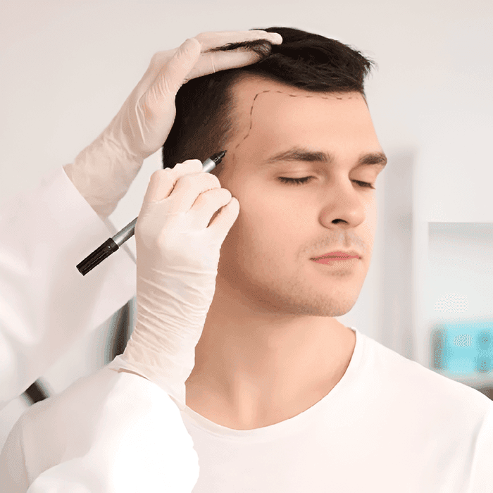 how-does-hair-transplant-work-