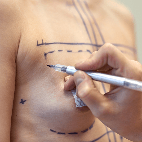 breast-augmentation-marking-skin