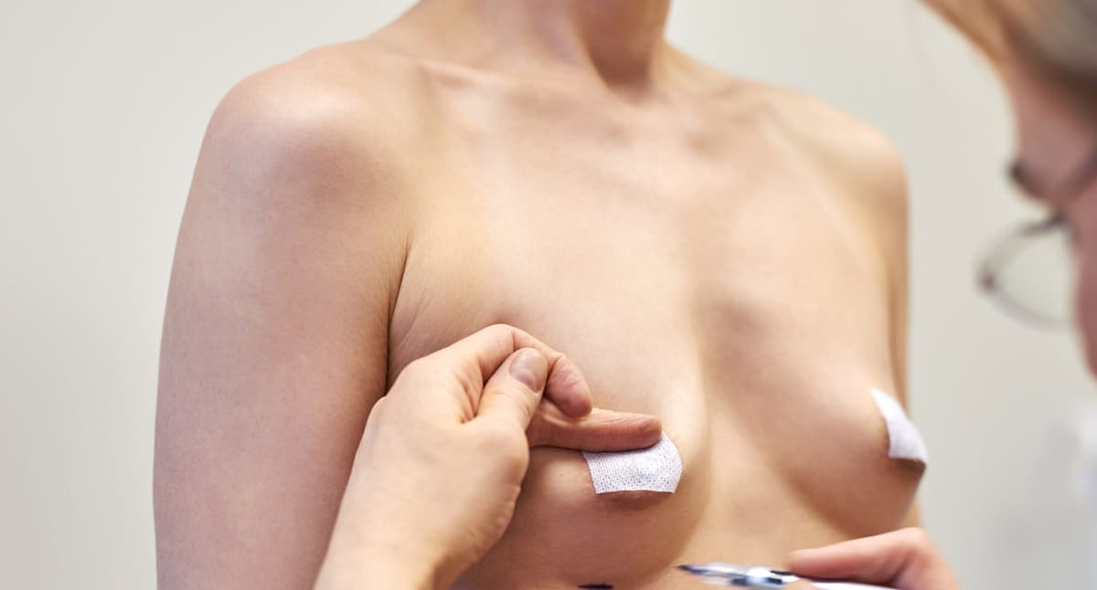 breast-augmentation-surgery-marks