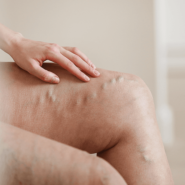 varicose-veins-legs